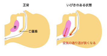 睡眠時無呼吸症候群について